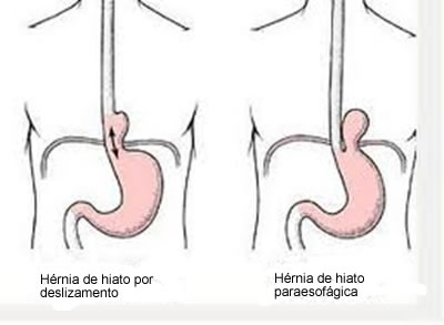 Hérnia de hiato Pessoas que têm hérnia de hiato podem sofrer de refluxo
