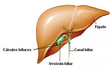 O c&aacute;lculo biliar pode ficar na pr&oacute;pria ves&iacute;cula, ir para o canal biliar ou ser empurrado para o intestino.